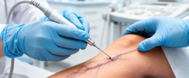 Endovenous Radiofrequency Ablation